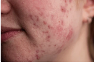 Acne & Scar Treatment