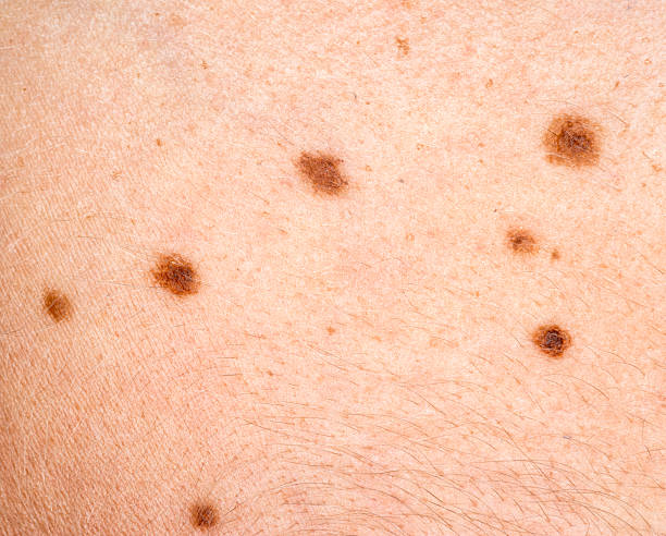 Melasma & Pigmentation