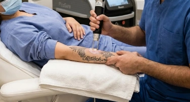 Tattoo Removal